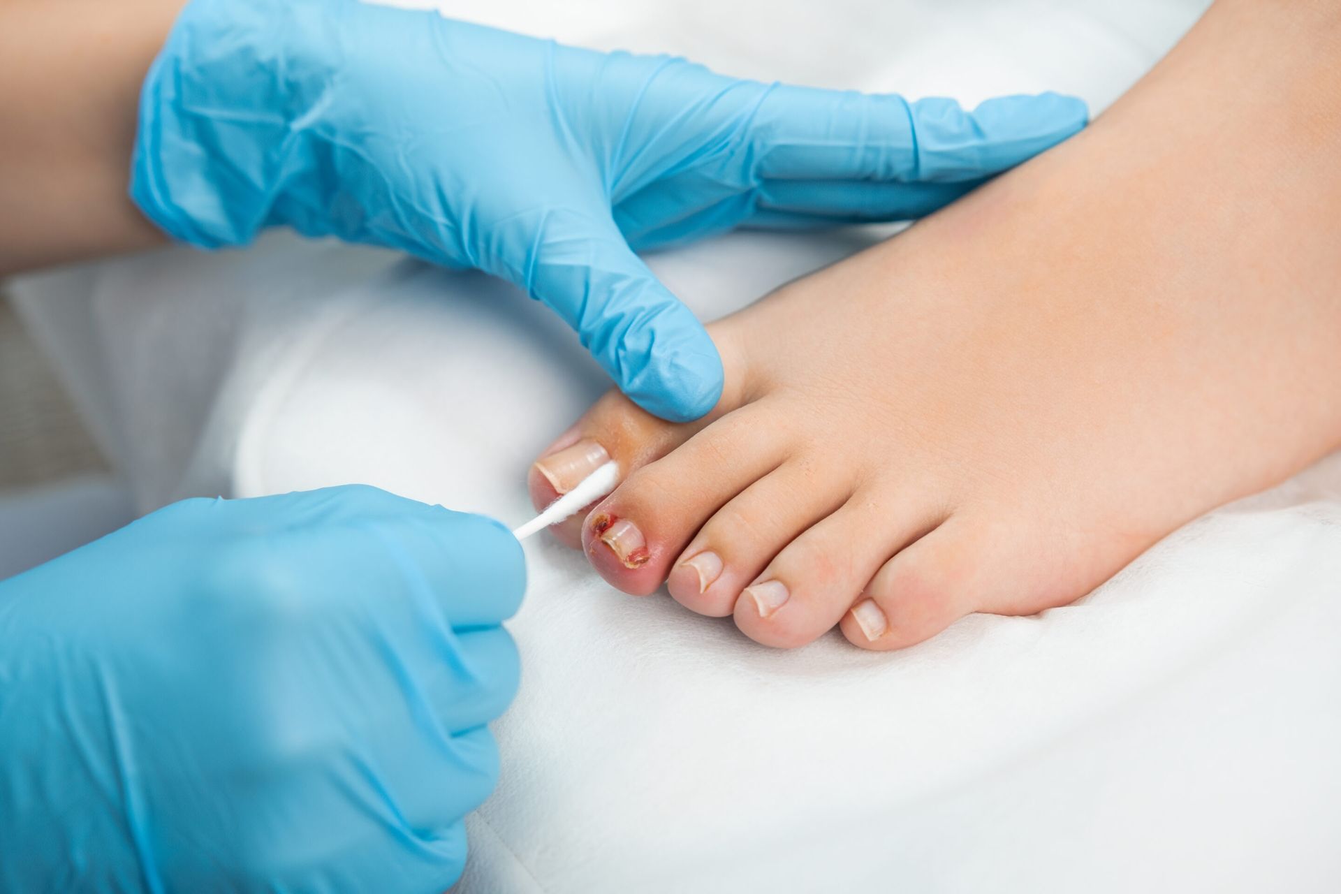 Person's foot being treated, with gloved hands using a cotton swab on a toenail.