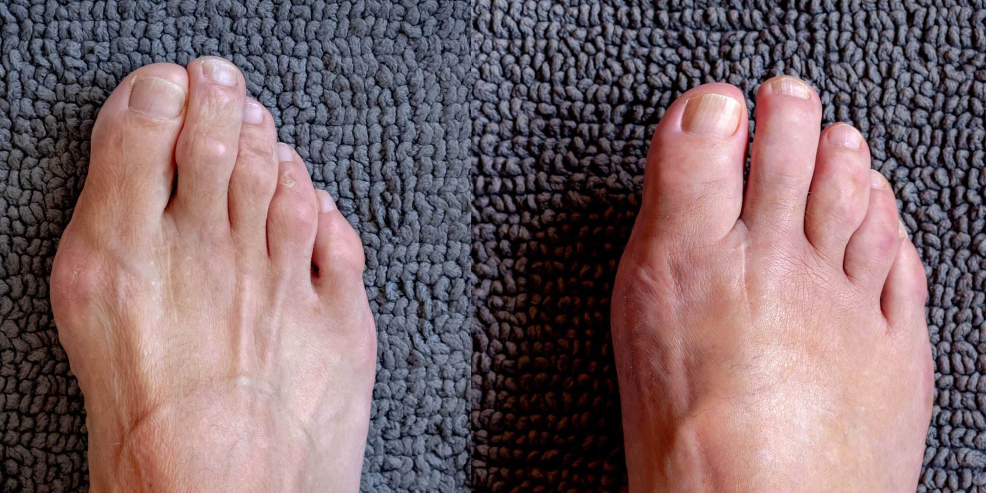 Two bare feet on a gray textured surface, showing the tops of the feet and toes.