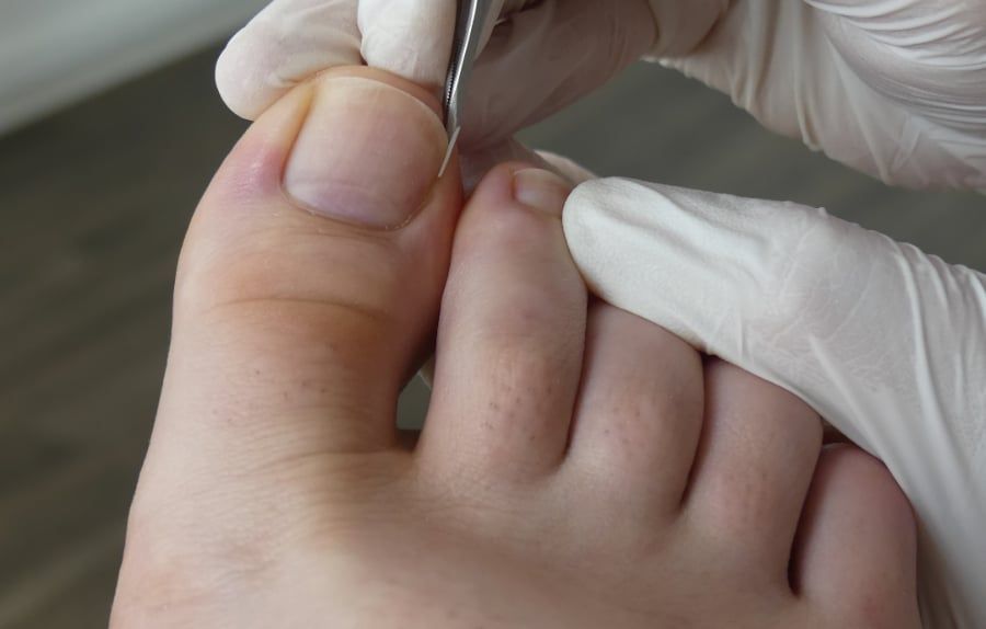 Foot with ingrown toenail being treated with tweezers, hands in gloves.