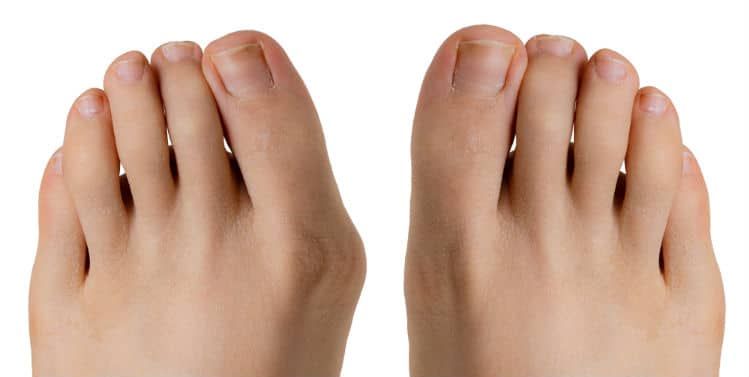 Pair of human feet, one with a bunion. Light skin tone, white background.