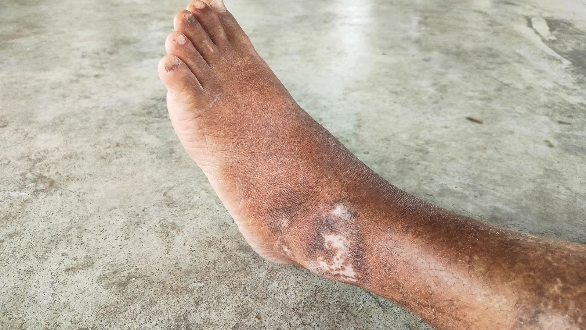Foot covered in sand, with patches of lighter skin.  On a concrete surface.