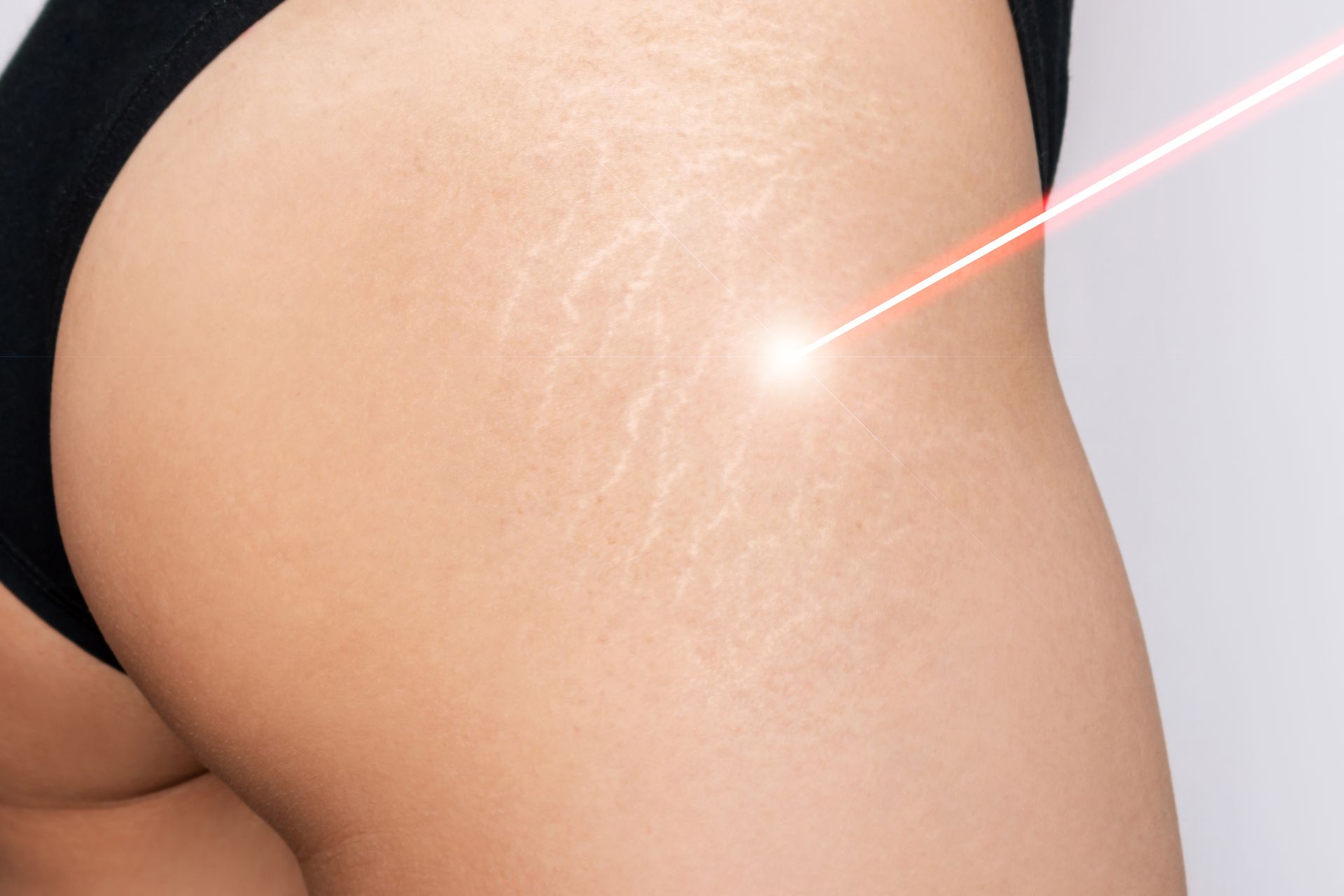 A woman is getting a laser treatment on her thigh to remove stretch marks.