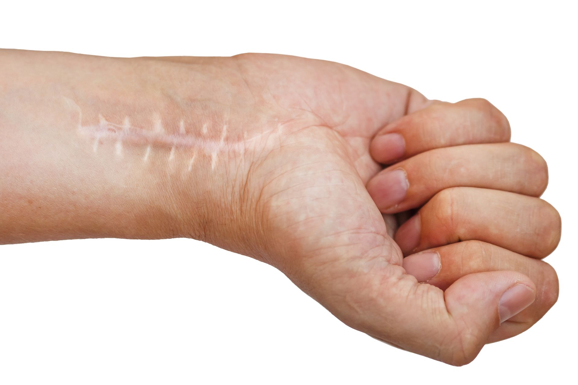 A close up of a person 's wrist with a scar on it.