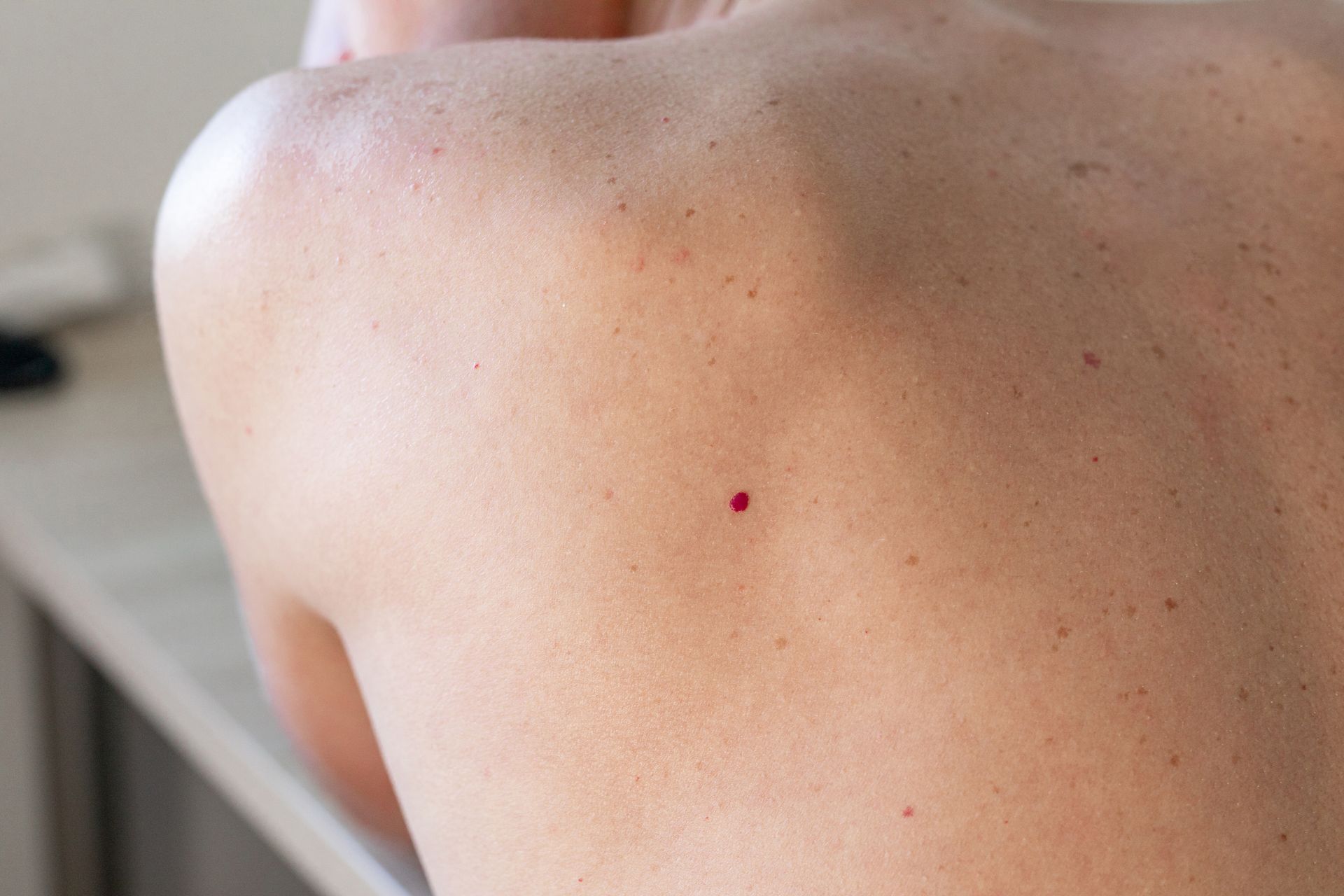 A close up of a person 's back with a red spot on it.