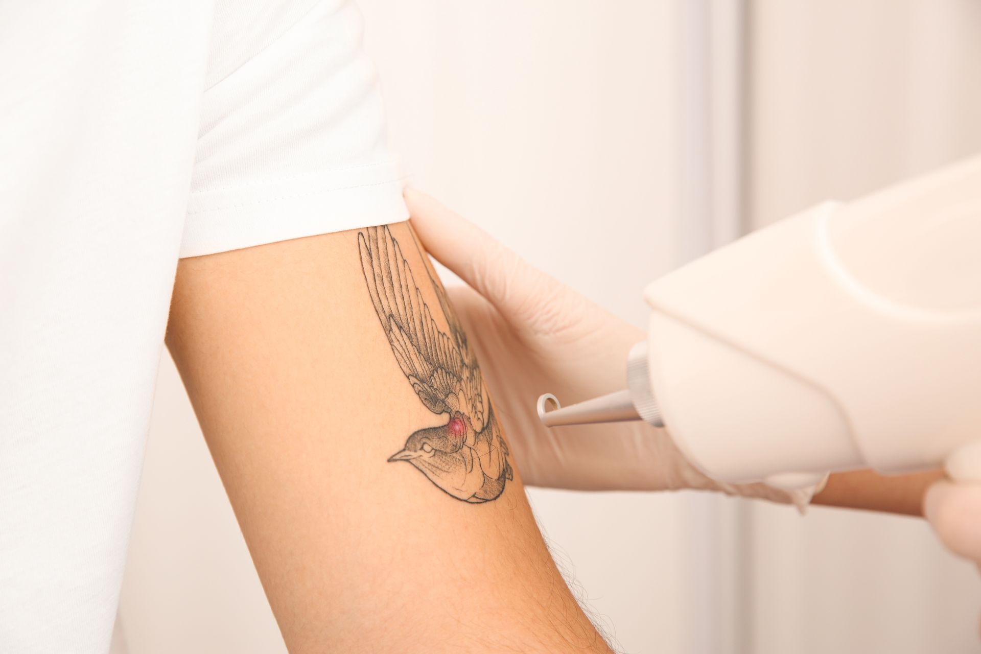 A woman is getting a tattoo removed from her arm.