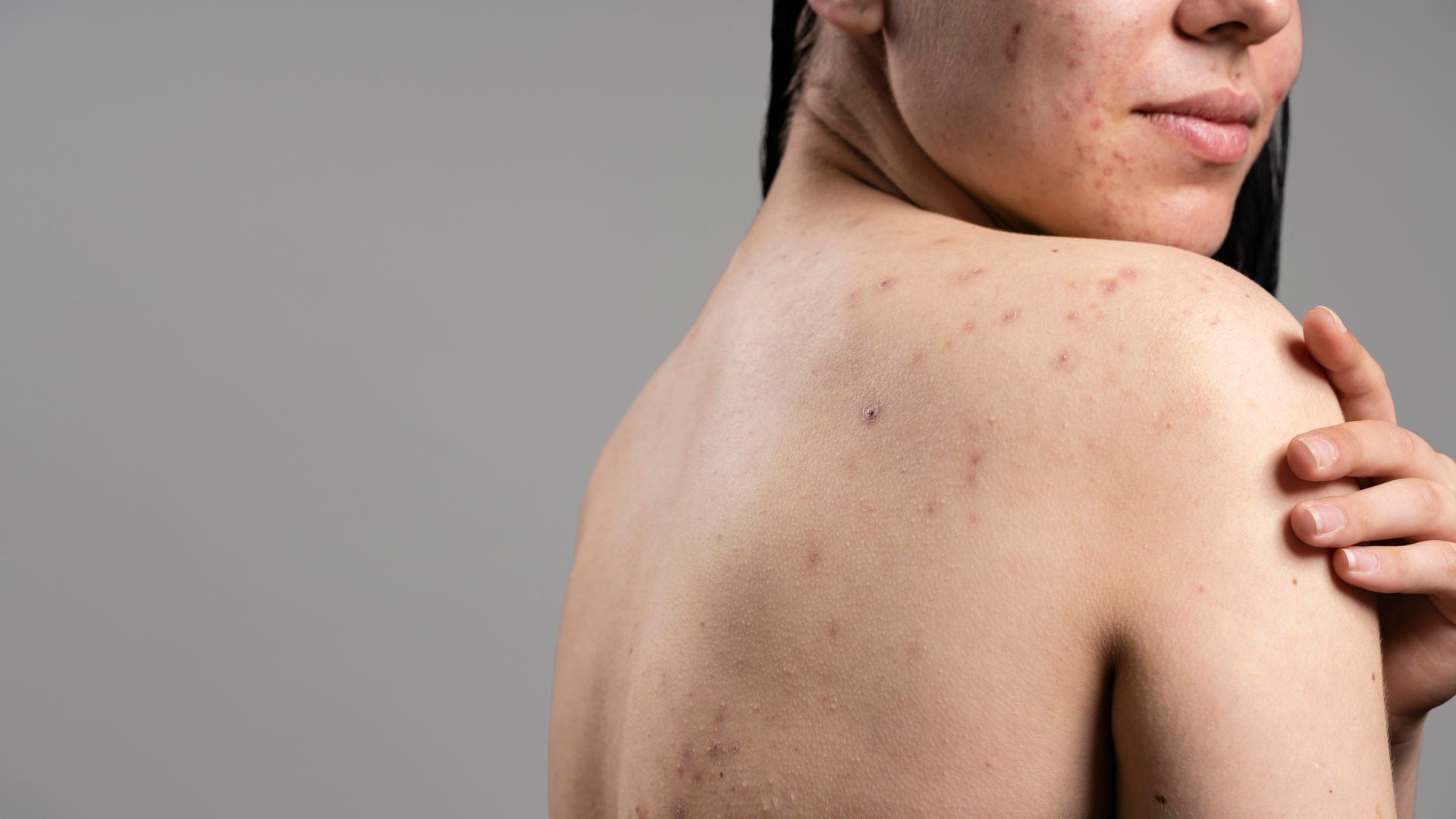 Woman with acne on back and shoulder, hand touching shoulder, neutral background.