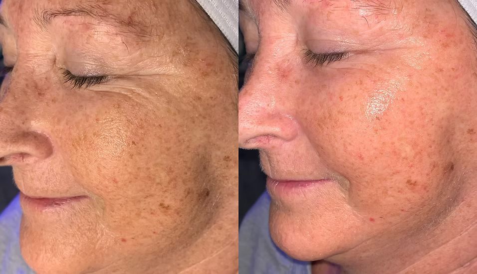 A before and after photo of a woman 's face with freckles.