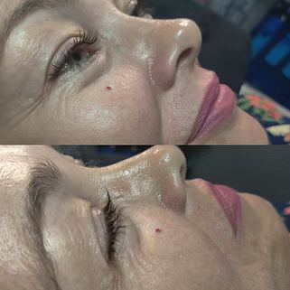 A woman 's face is shown before and after a nose job.