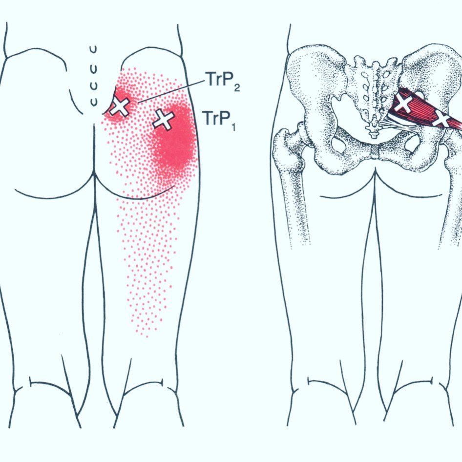 bil pijn gluteus medius