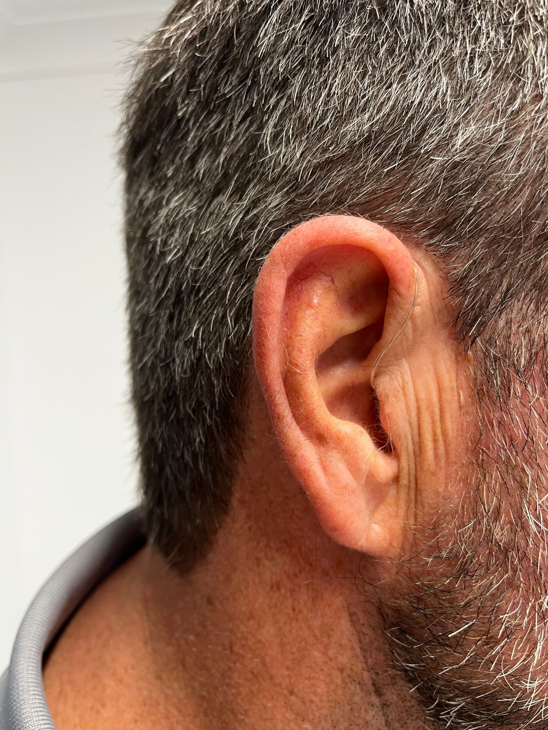 A Woman is Getting a Hearing Aid Put in Her Ear — Clayton Hearing in Pialba, QLD