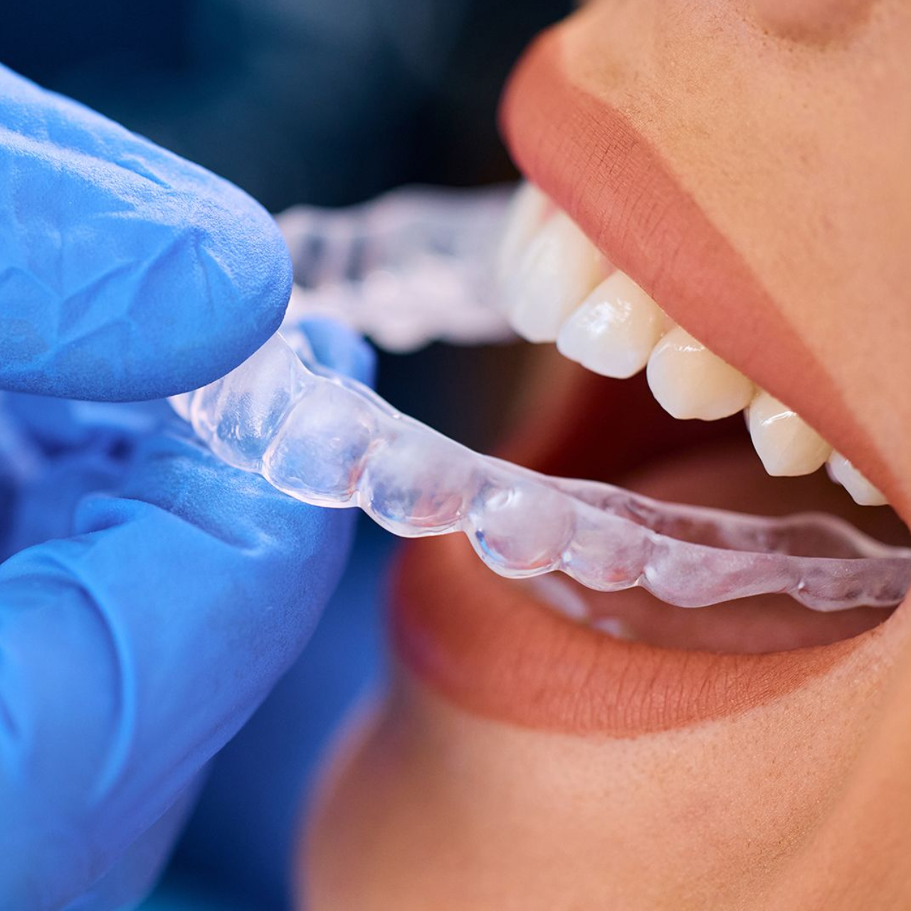 CLEAR ALIGNER TREATMENT