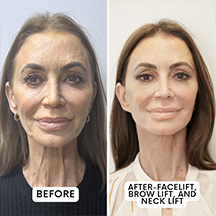 A before and after photo of a woman 's face.