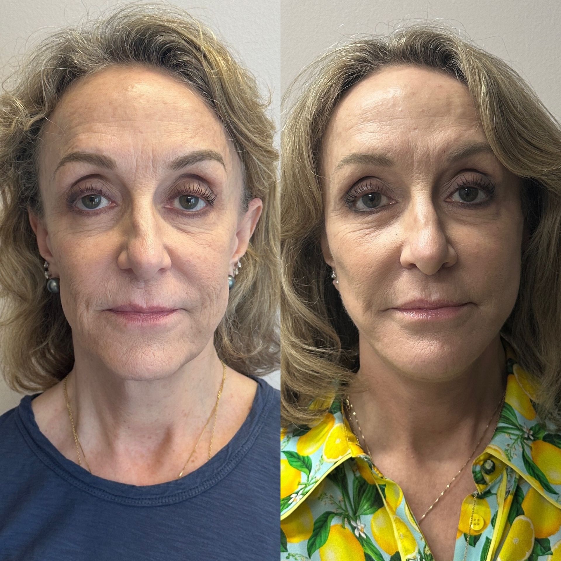 A before and after photo of an older blonde woman 's face front view.