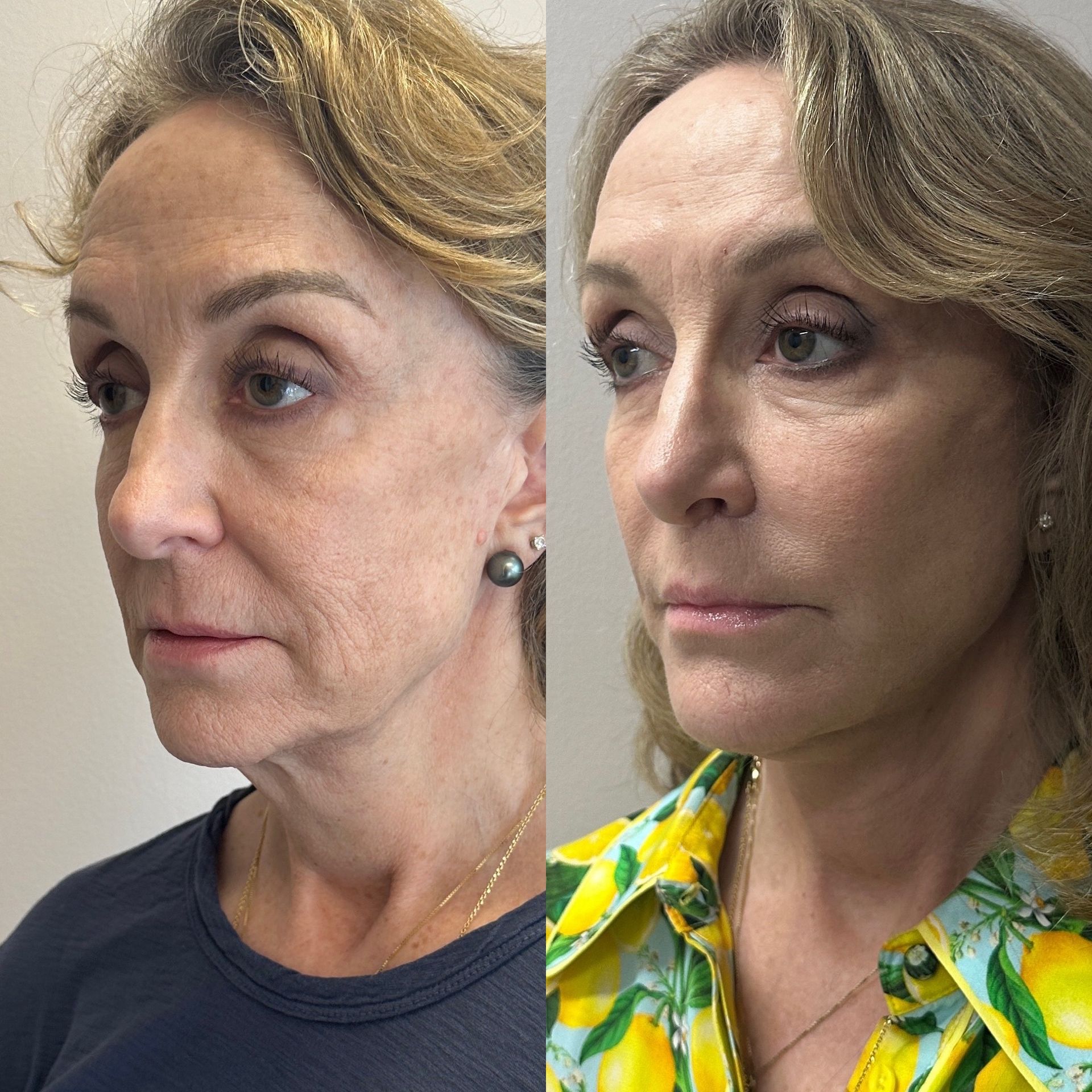 A before and after photo of a woman 's face.