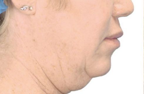 A close up of a woman 's face with a double chin.