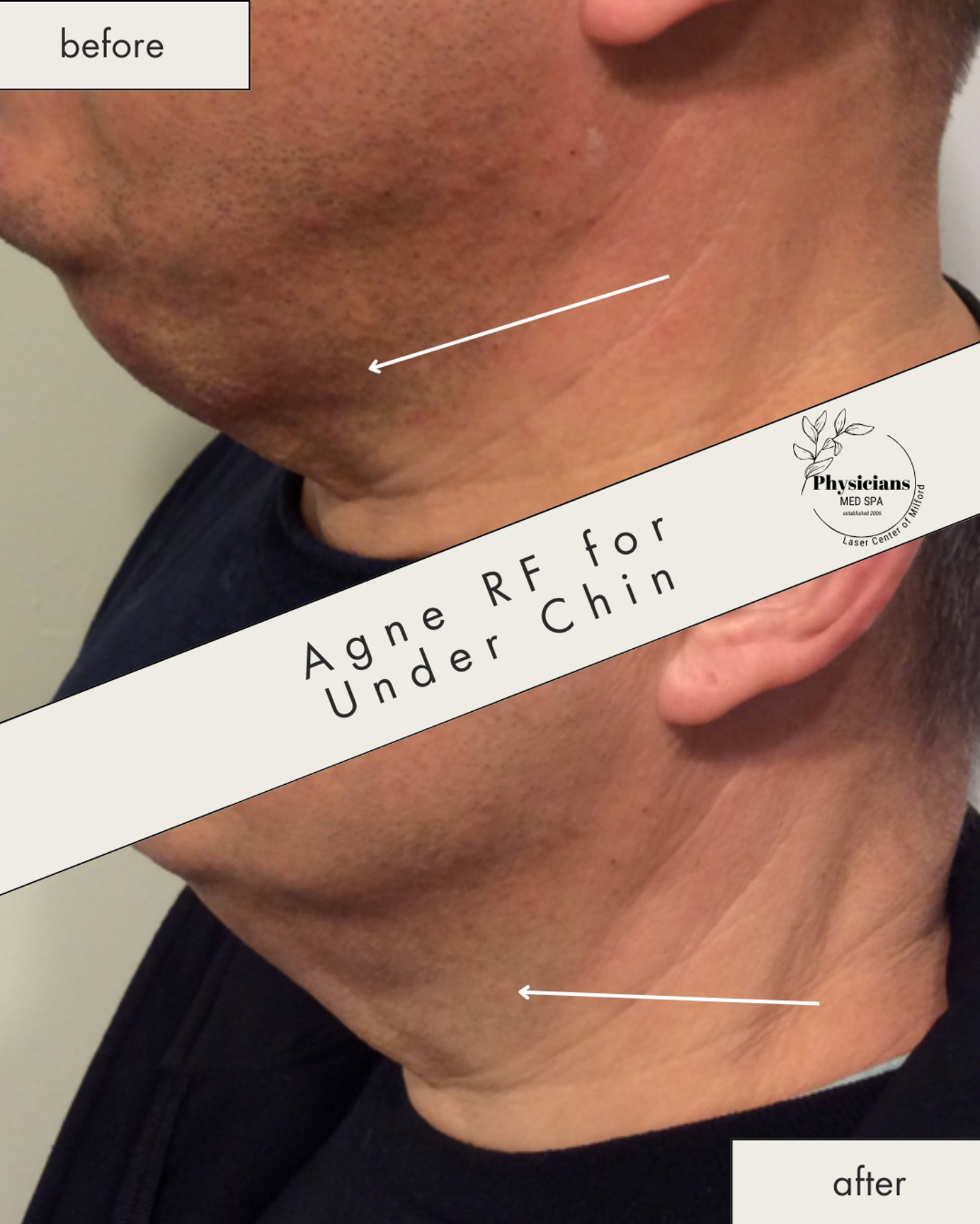 AgnesRF for 2 Weeks after Lipolysis