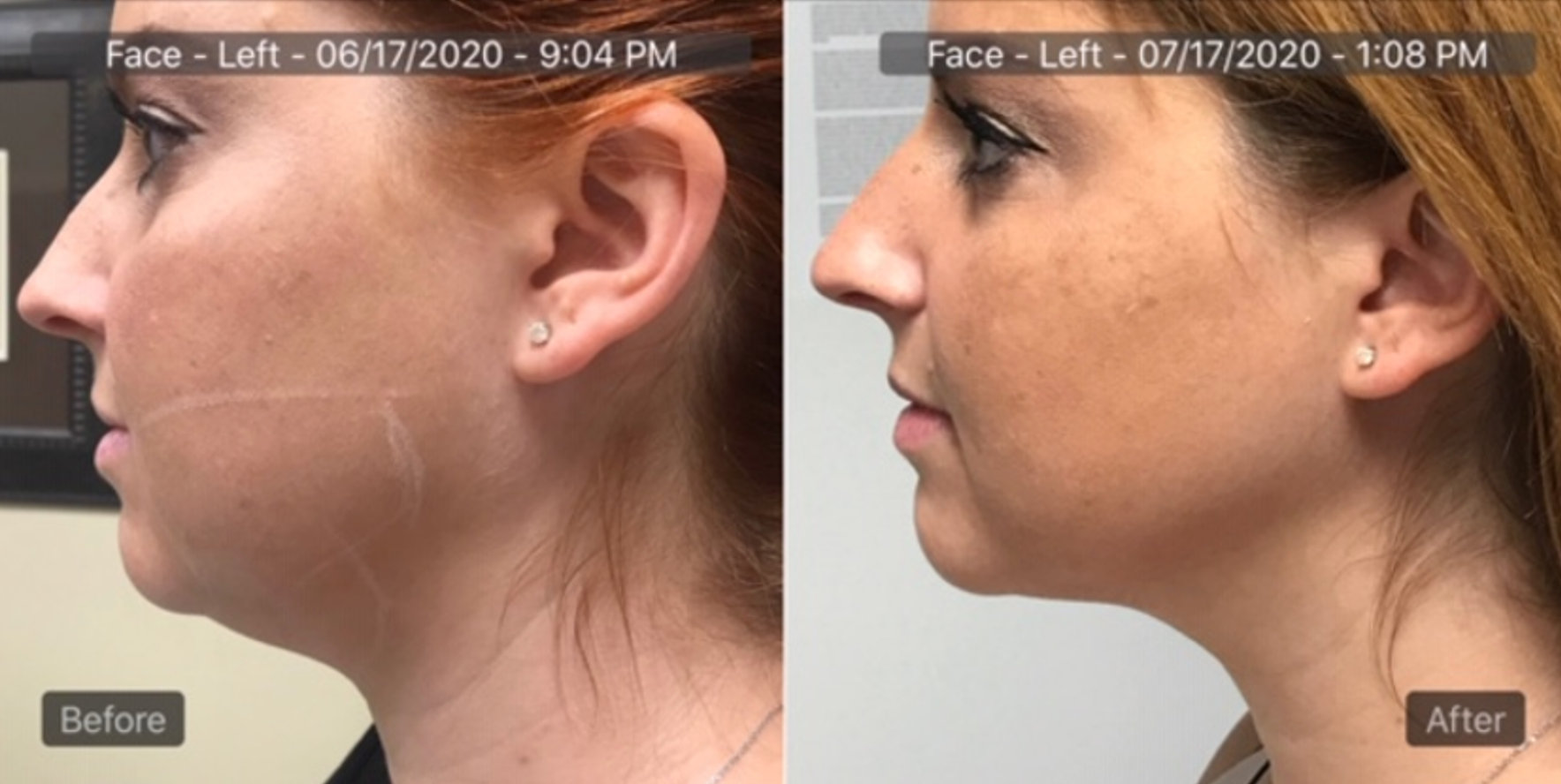 AgnesRF for Double Chin Lipolysis