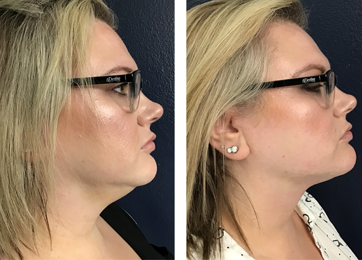 AgnesRF for Double Chin Lipolysis
