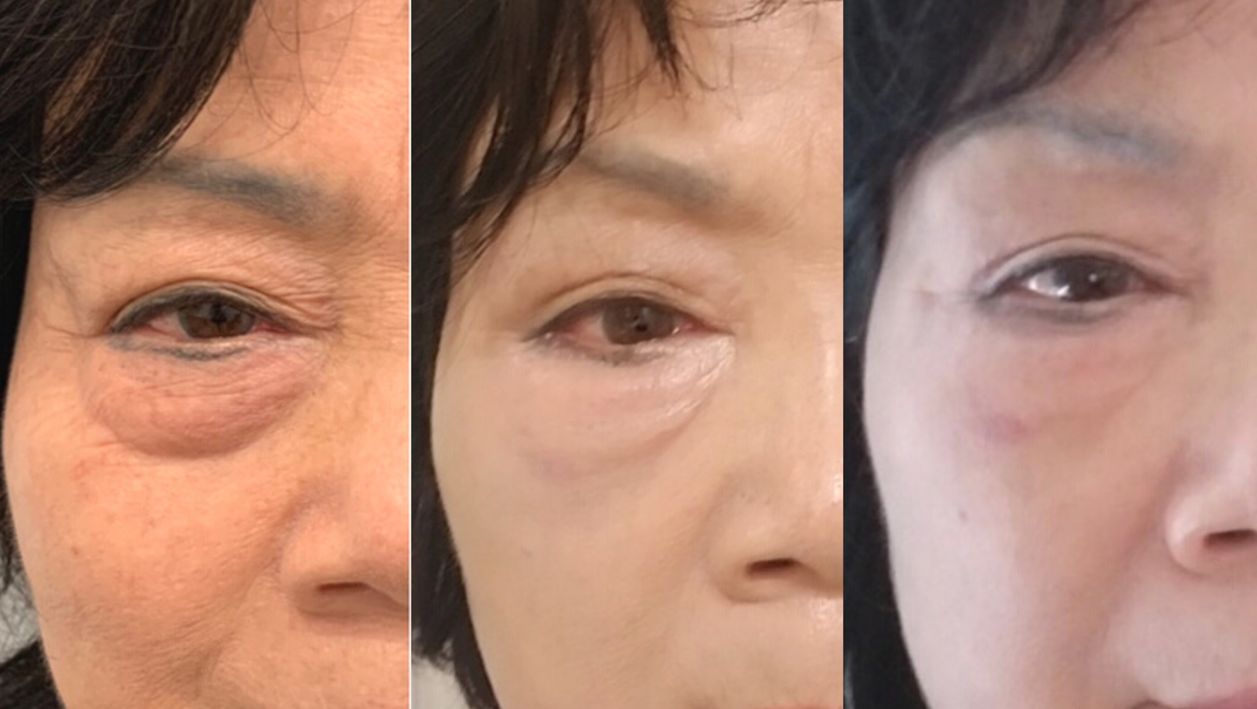 AgnesRF for Undereye Lipolysis