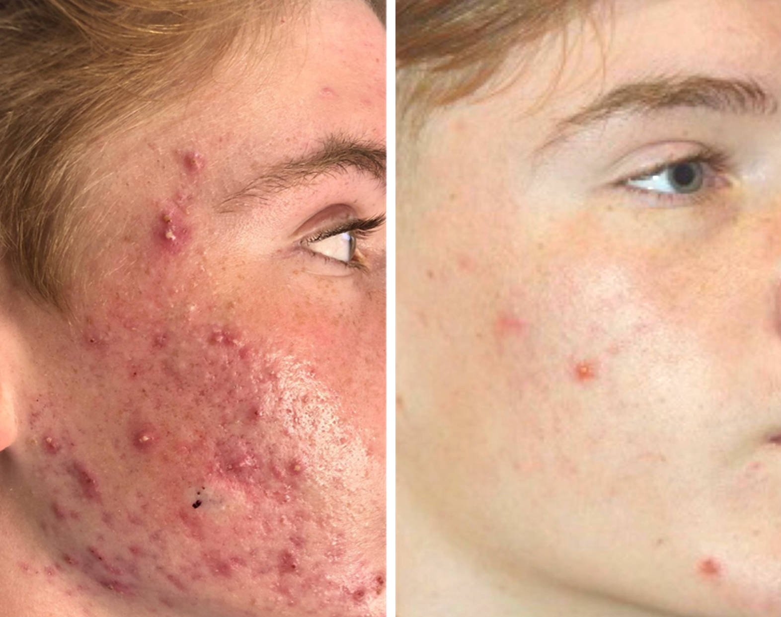 AgnesRF for Acne Destruction