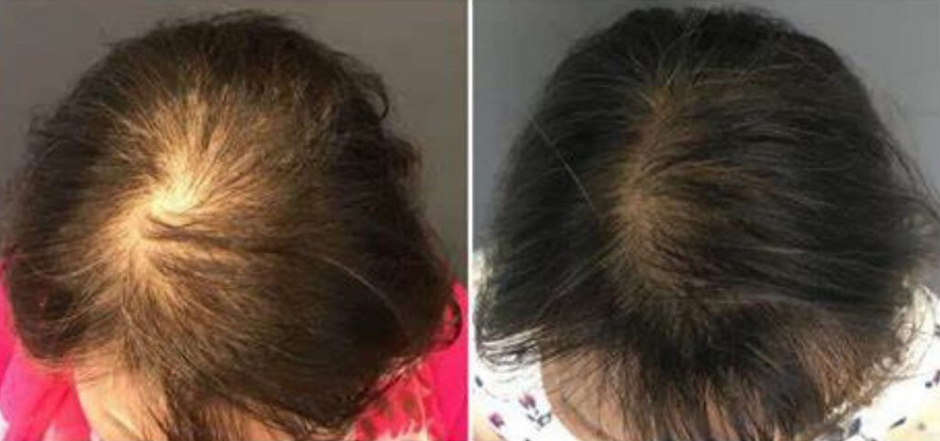 AquaFirme XS for Hair Loss