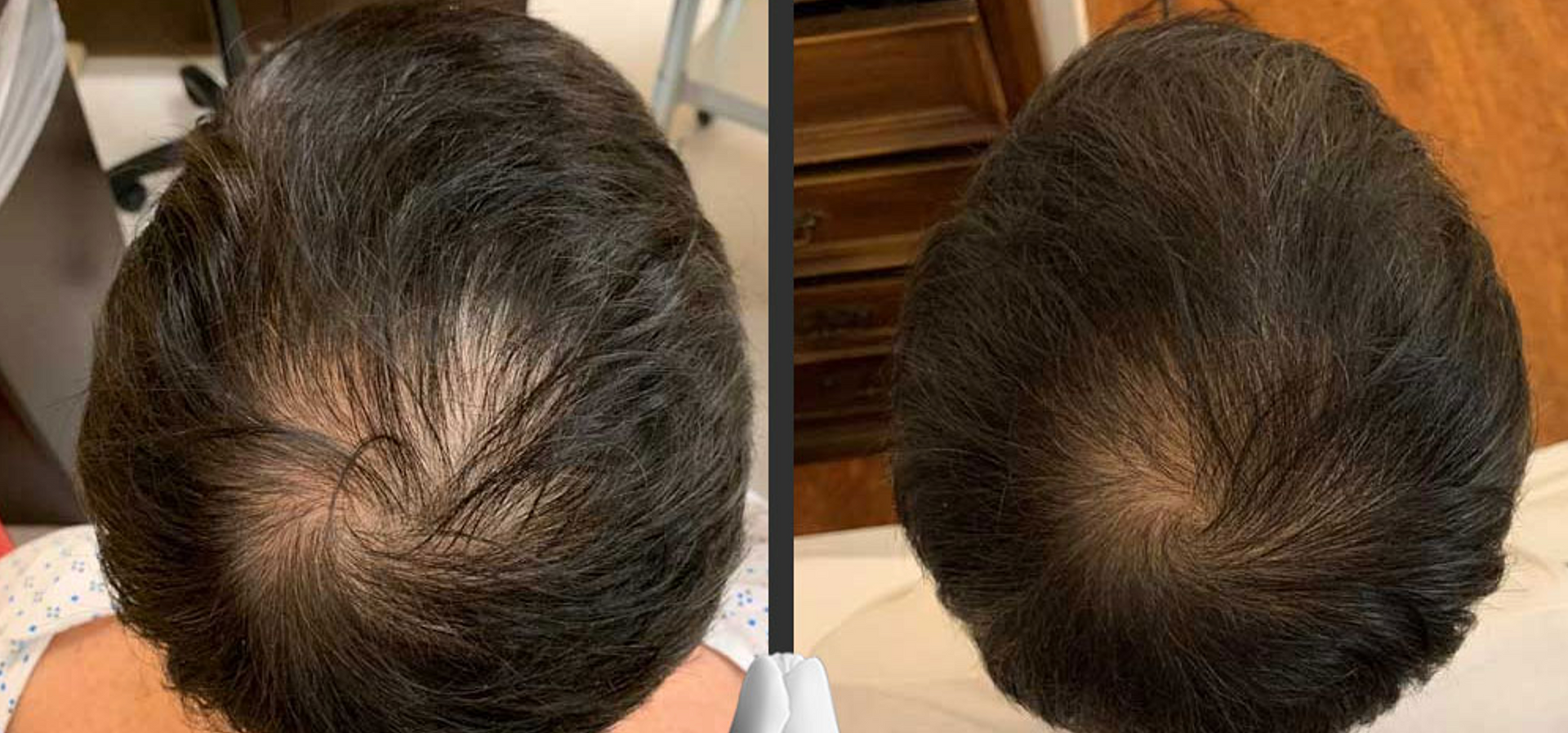 AquaFirme XS for Hair Loss