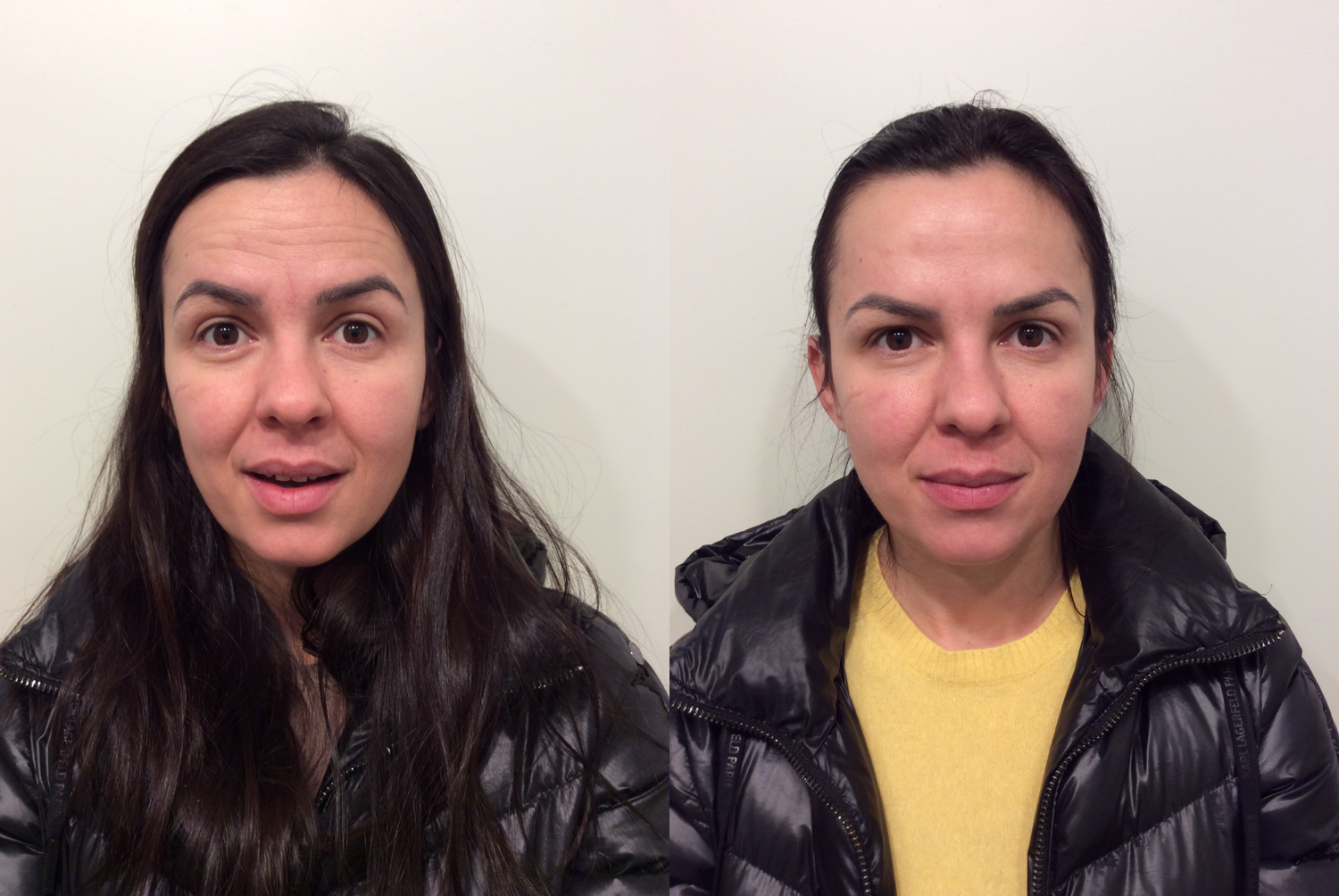 20 units in forehead