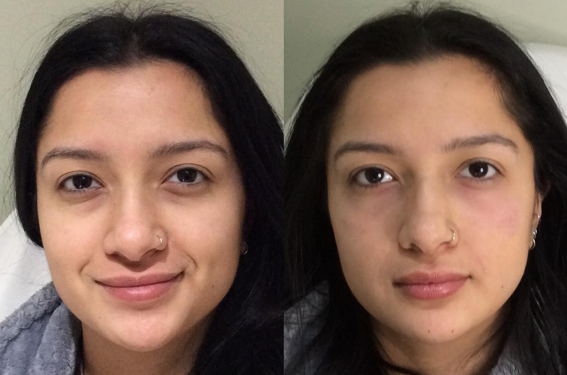 Dermal Filler for Improved Shadows