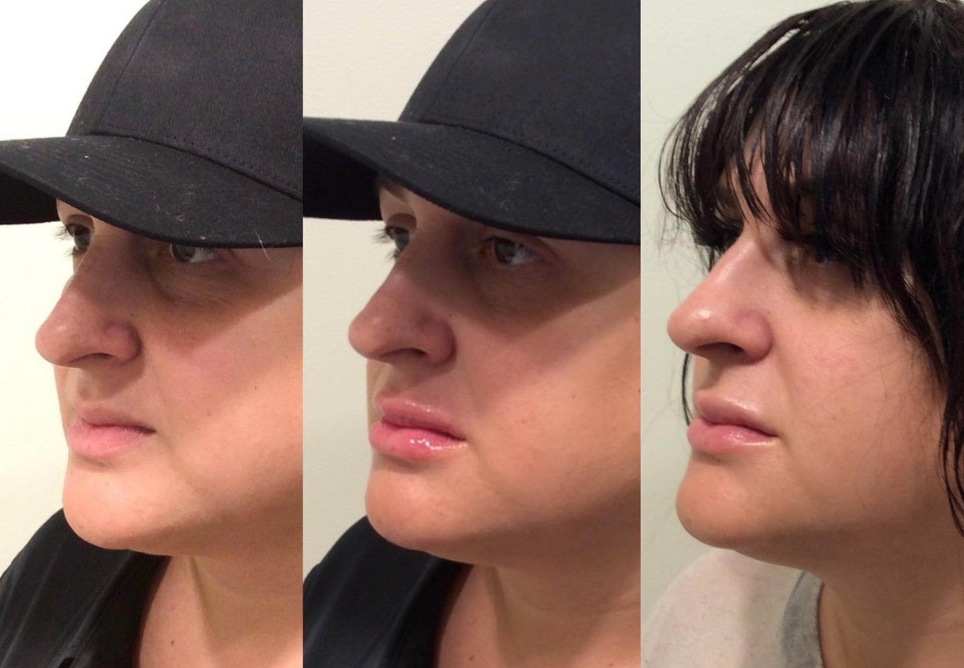 Dermal Filler for Luscious Lips