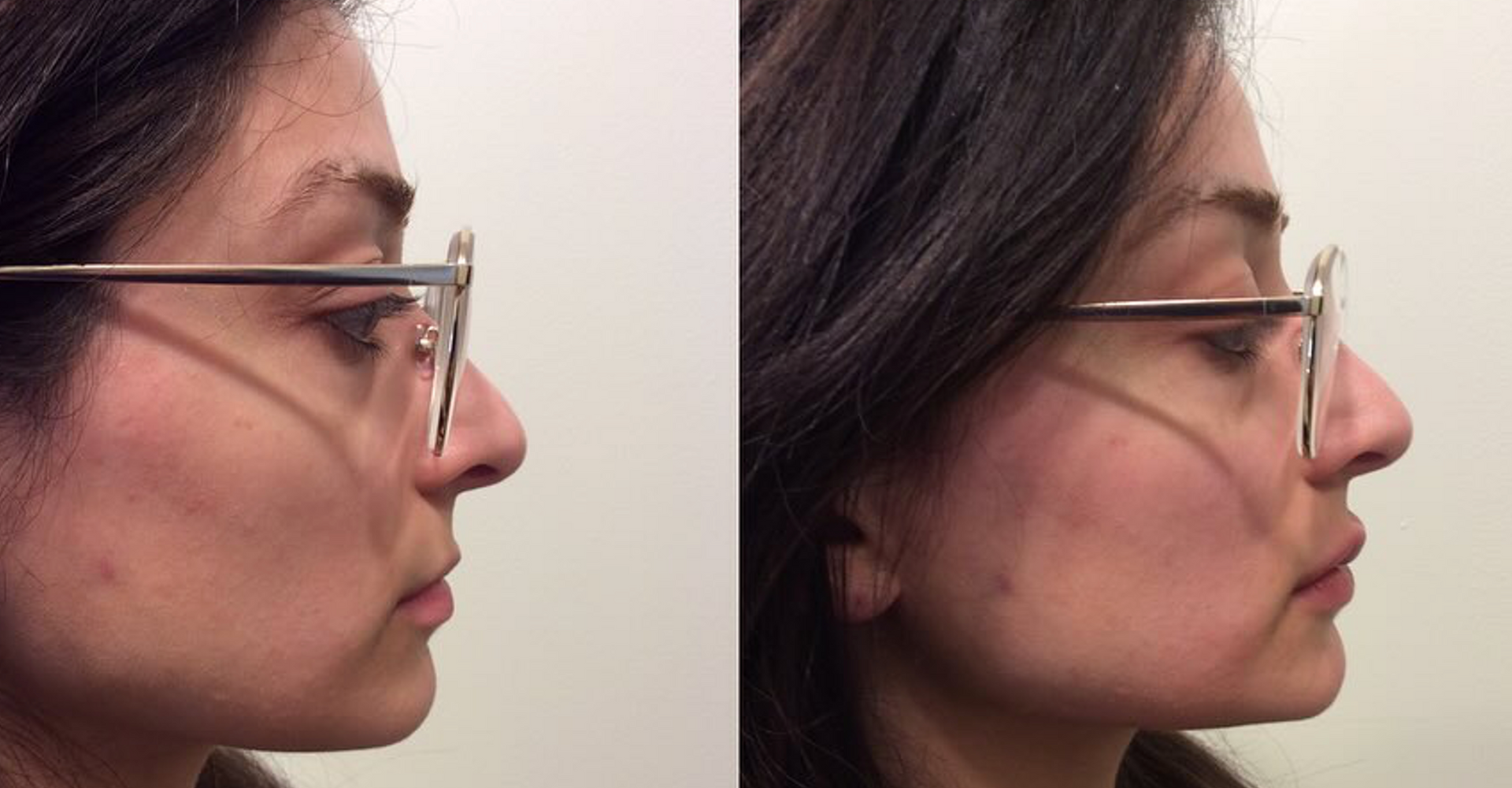Dermal Filler for Perfect Profile