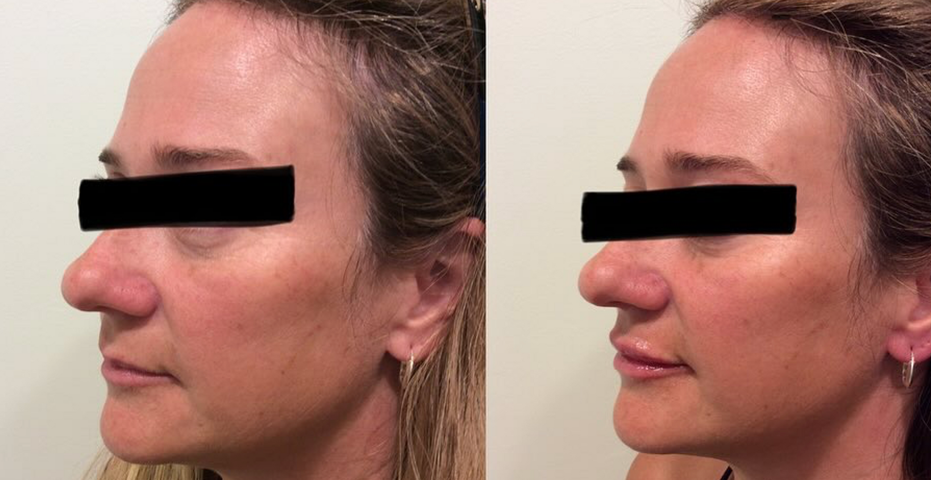 Dermal Filler for Plump Pout