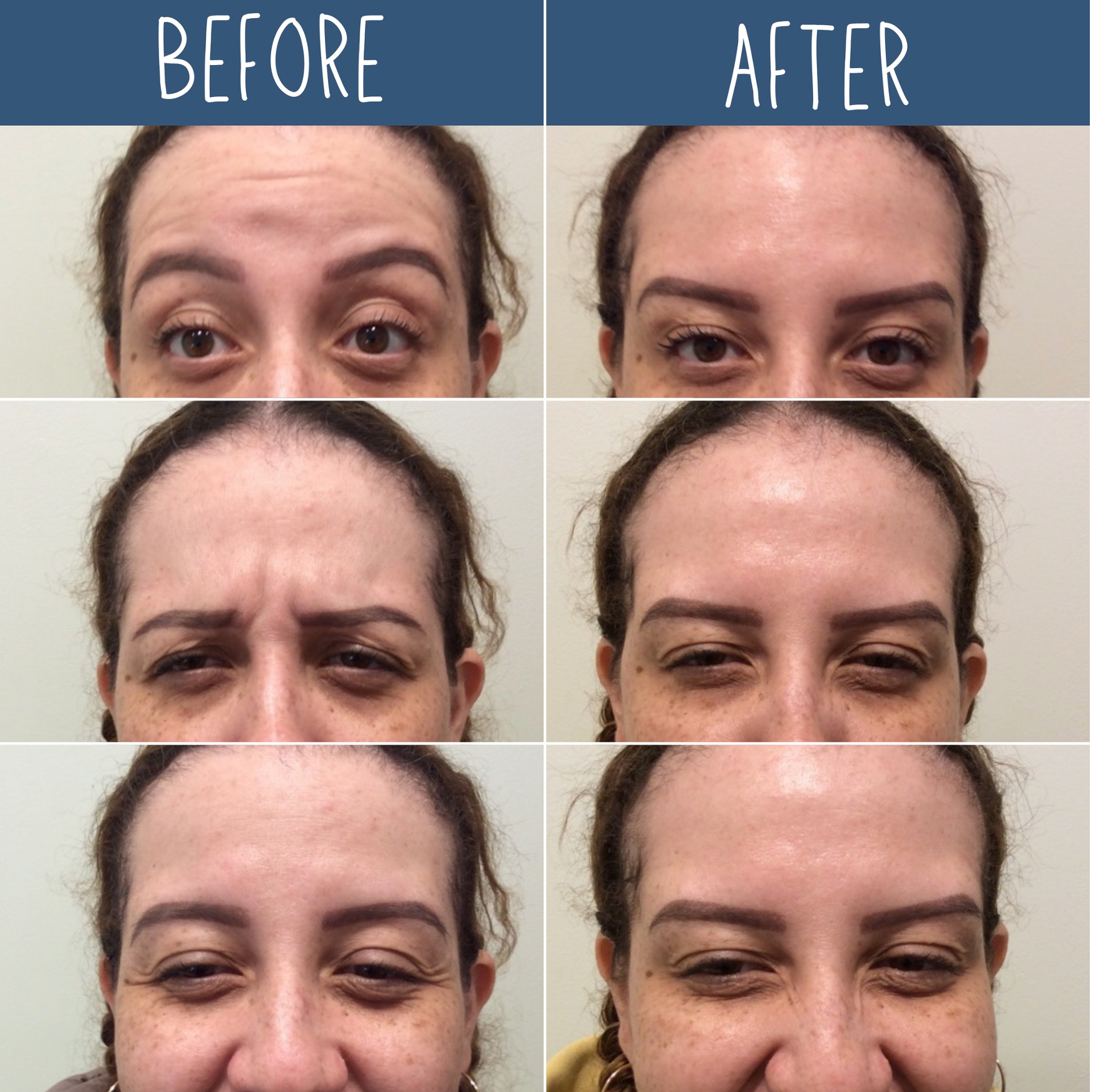 Dysport Look of Three