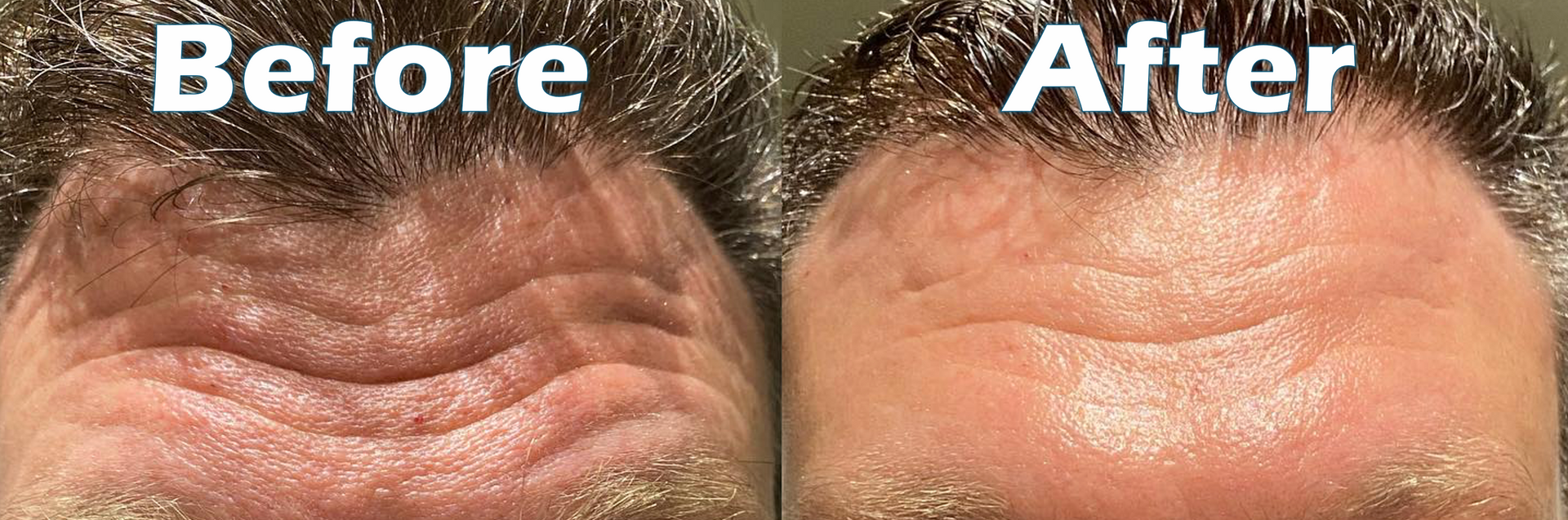 Fractional Resurfacing