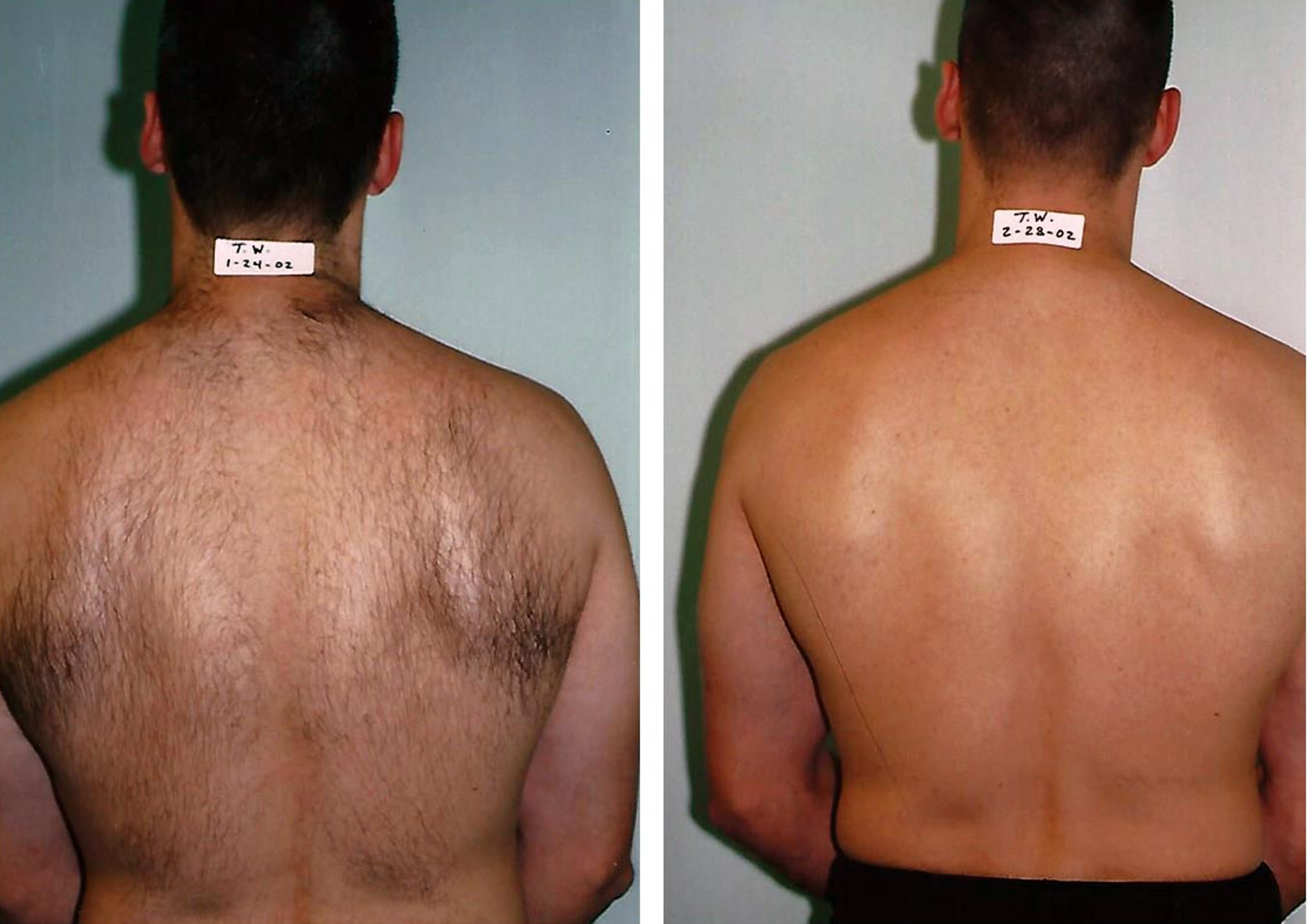 Laser Hair Removal 2