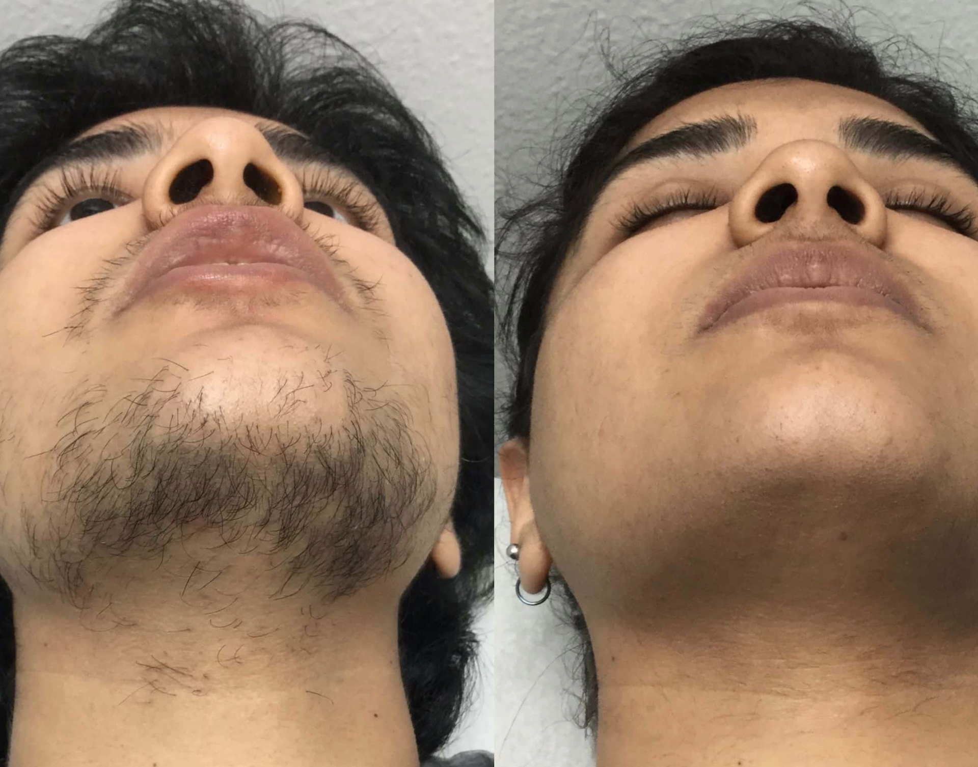 Laser Hair Removal 3