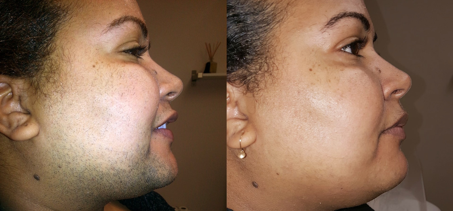 Laser Hair Removal 1