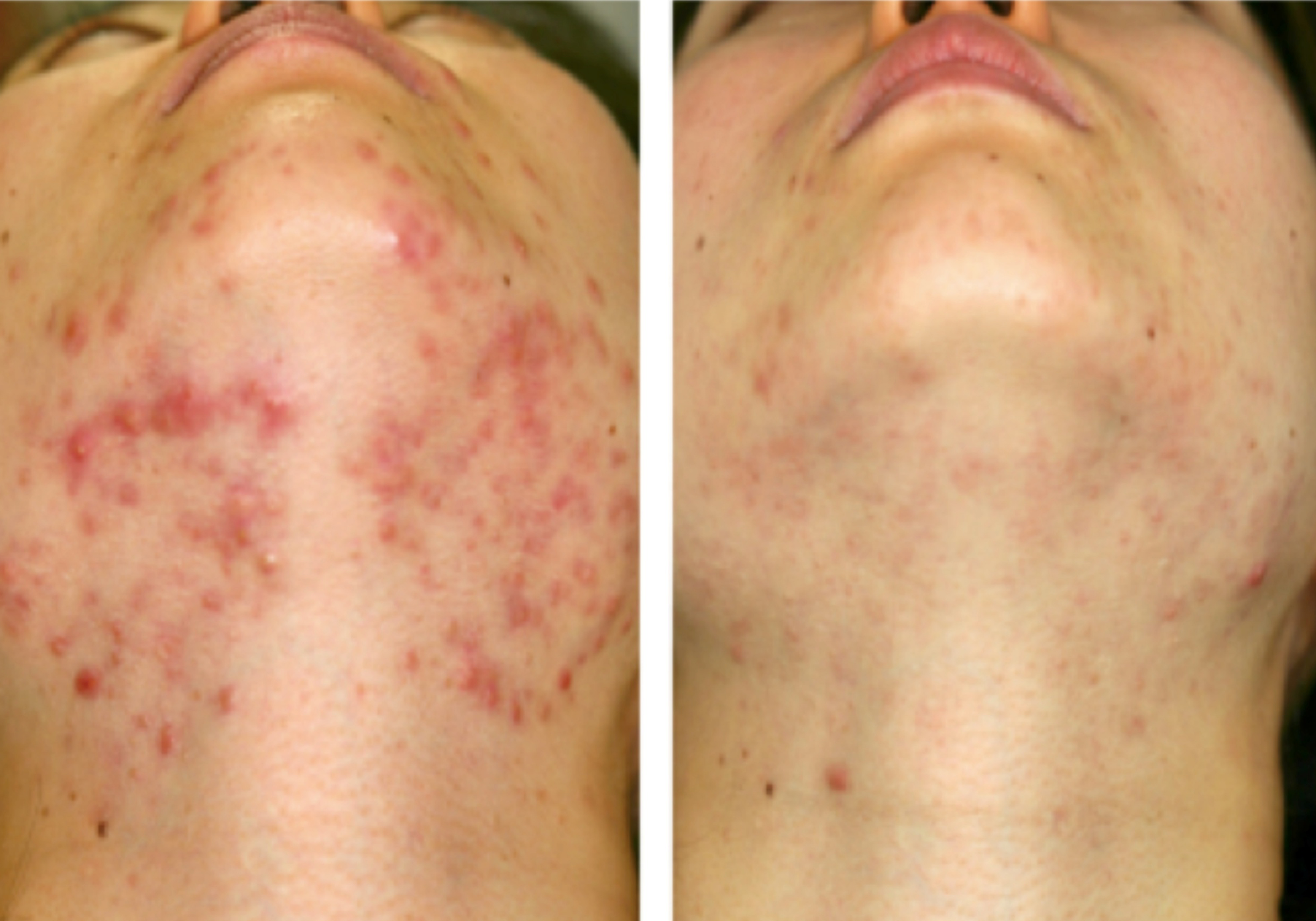 Plasmage for Acne Scarring
