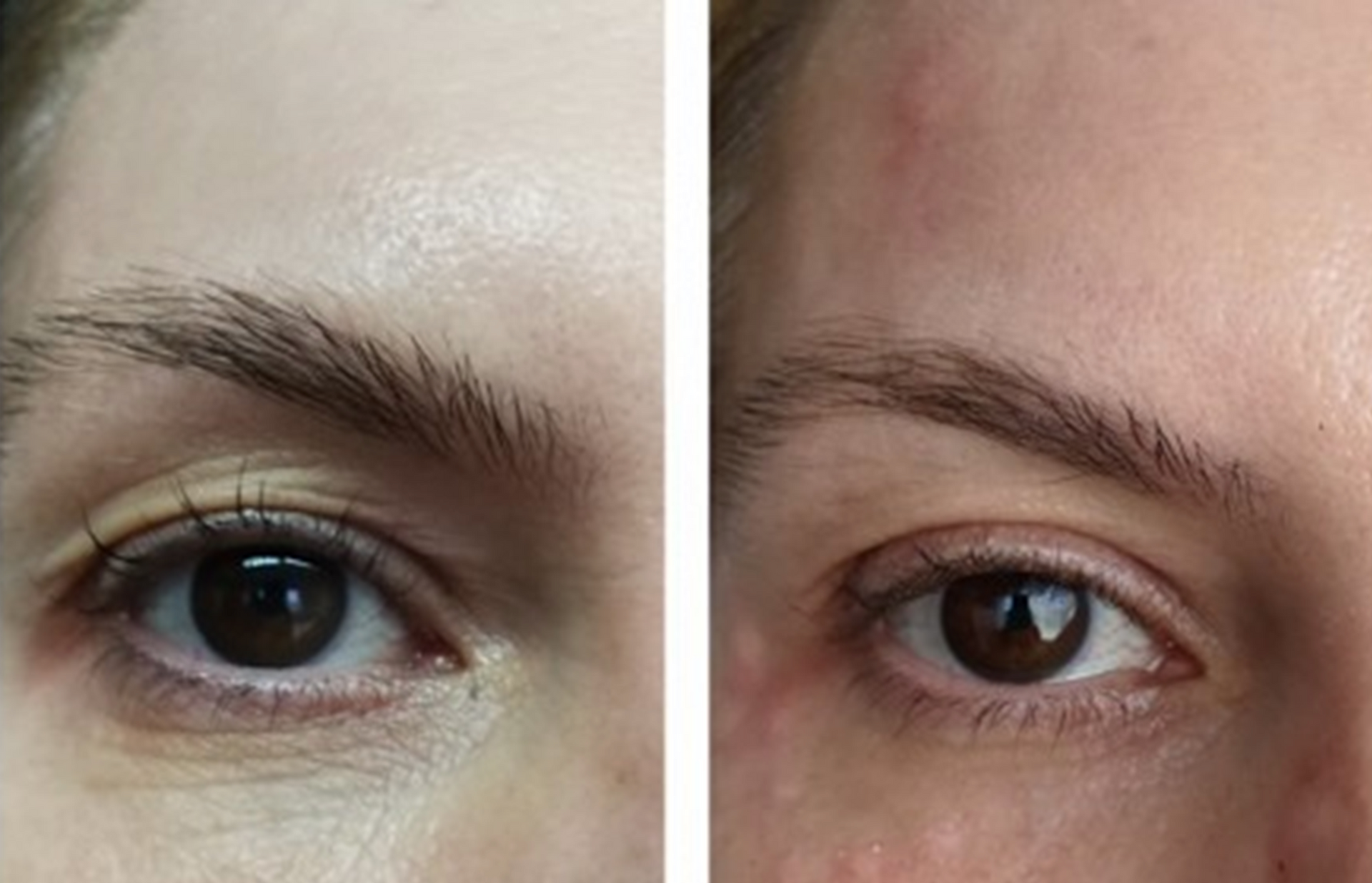 Plasmage for Blepharoplasma