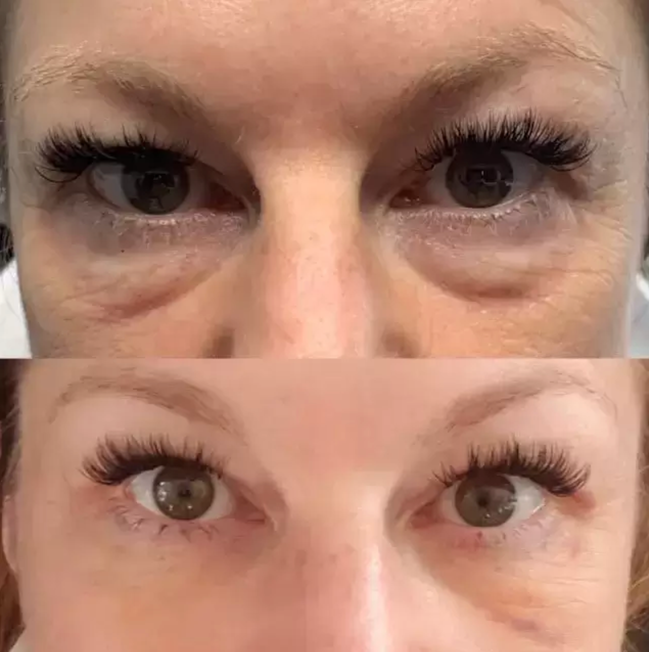 Plasmage for Eye Tightening