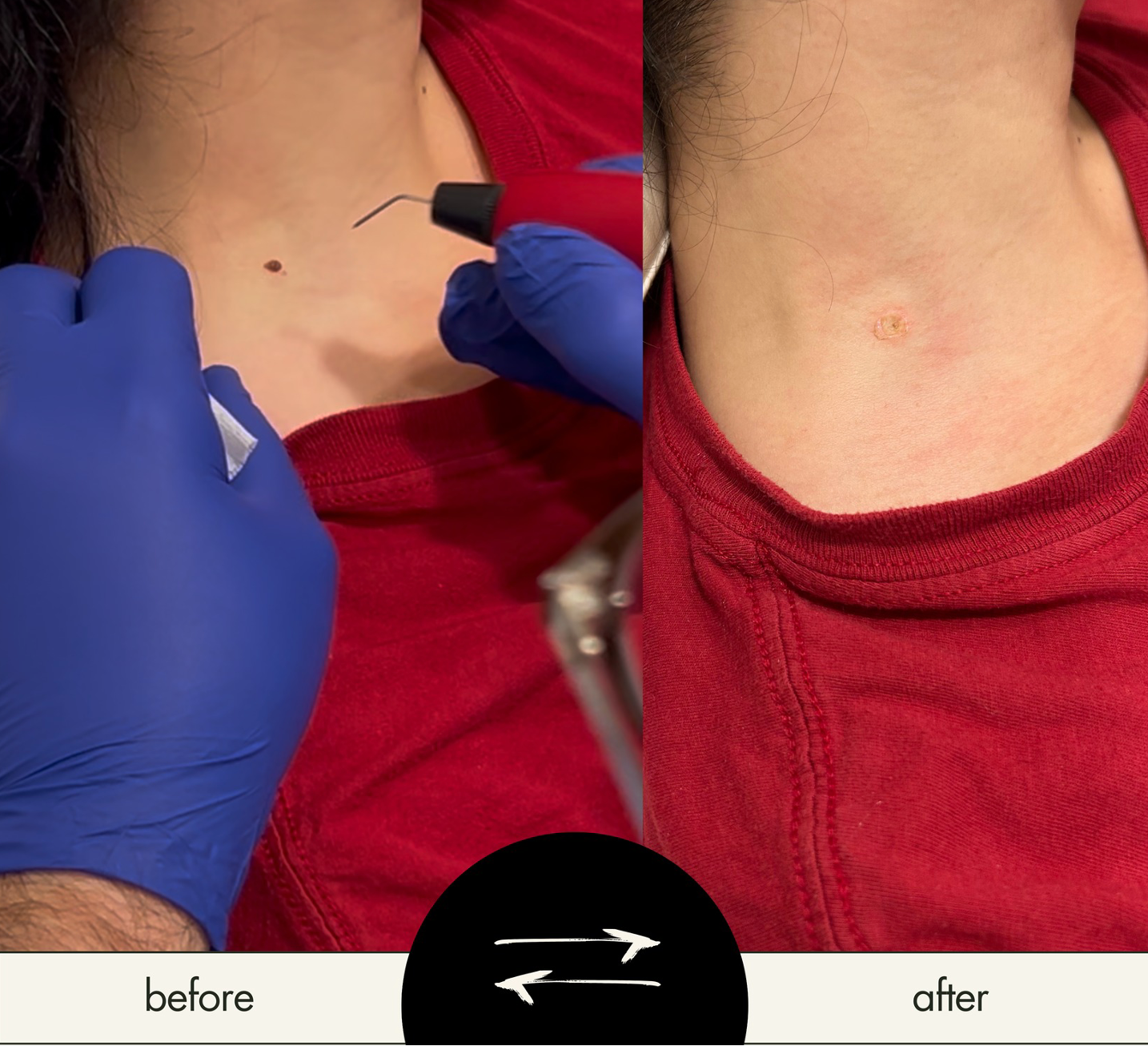 Plasmage for Lesion Removal