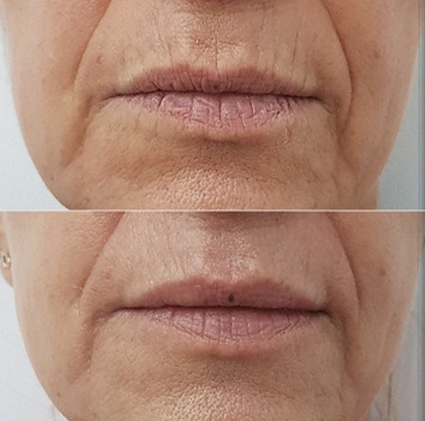 Plasmage for Smokers Lines