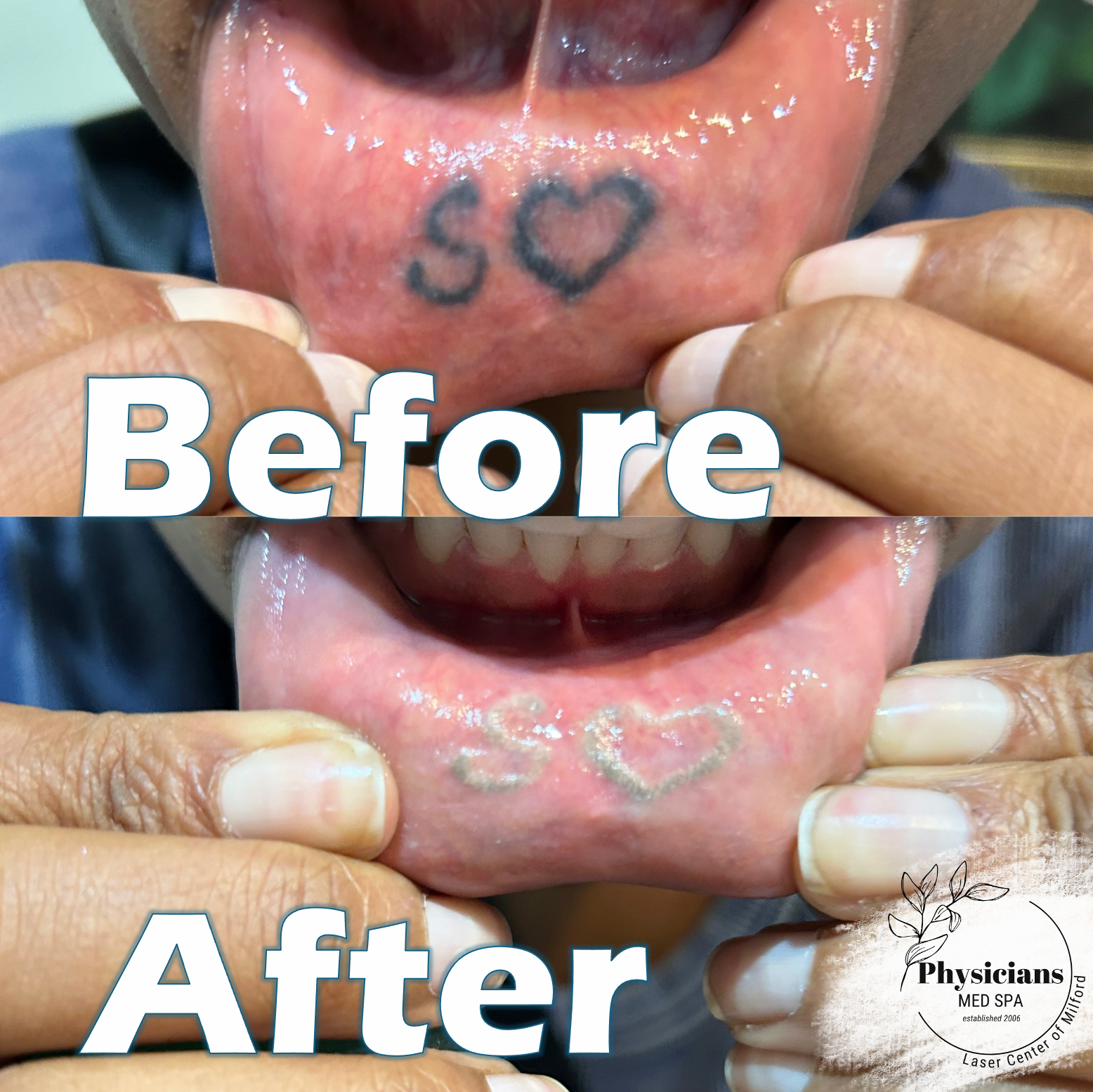 Pico Laser for Tattoo Removal