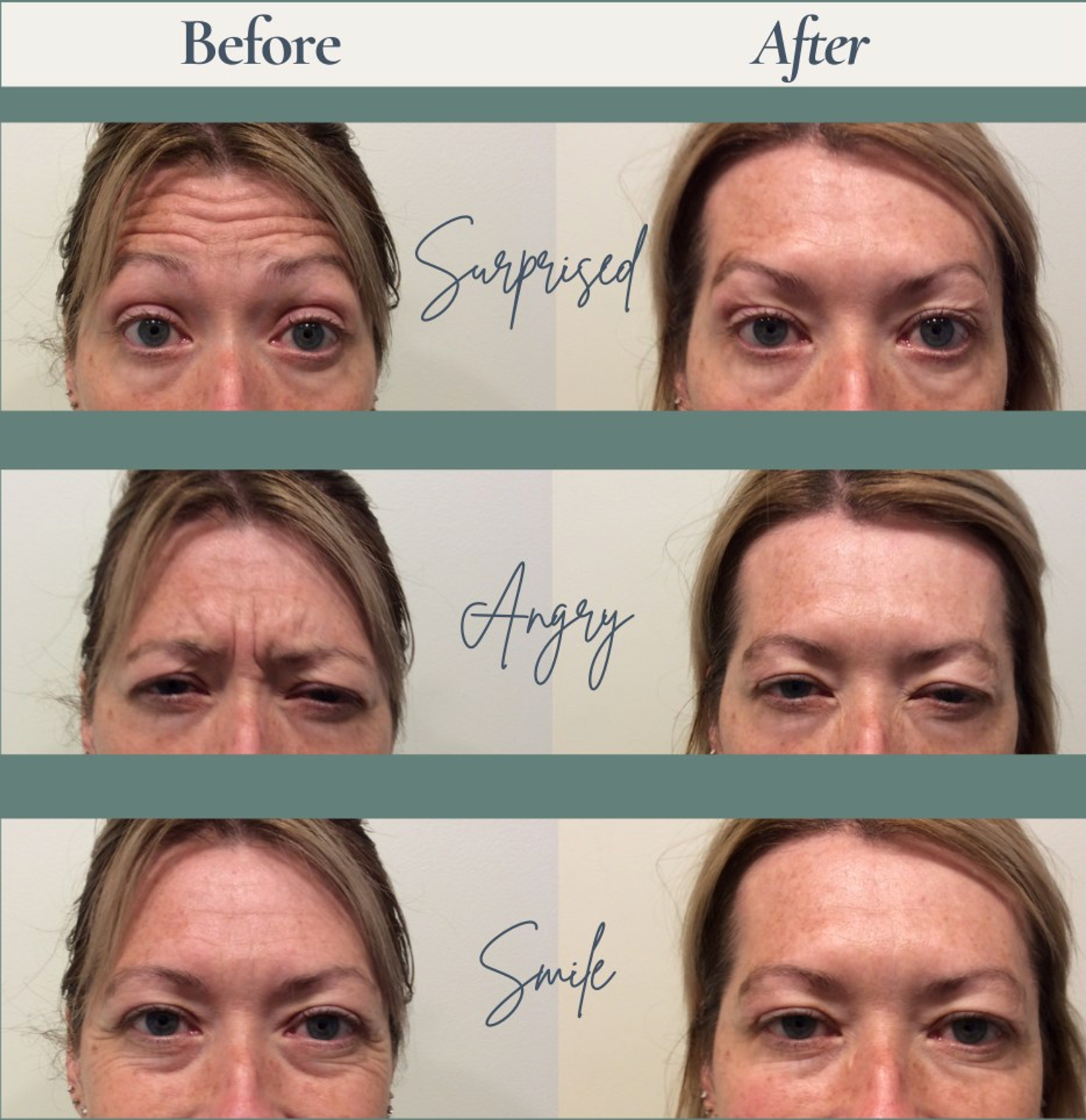 Xeomin Look of Three