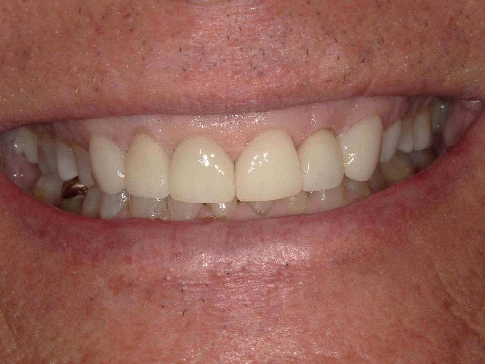 Dr. Michael Yang DDS - crowns