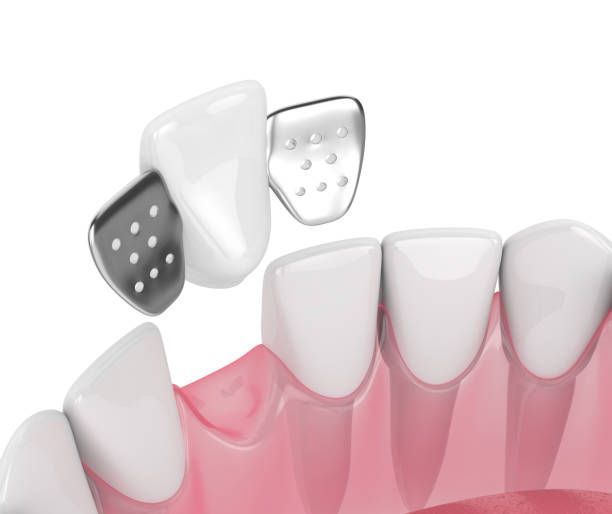 Illustration showing a dental bridge replacing a missing tooth in the upper jaw.