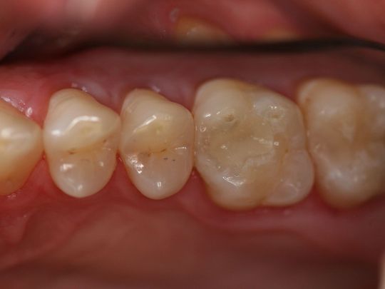 Tustin Dentist - composite fillings