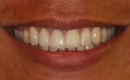 Michael Yang DDS - crowns