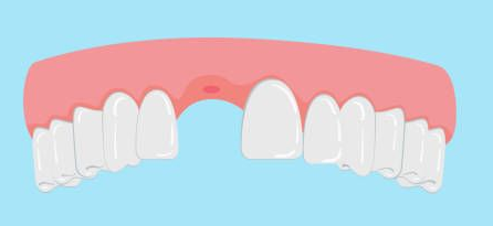 Gums and teeth, with a missing tooth in the upper jaw.