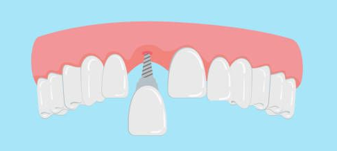 Dental implant process: an implant post placed in the jawbone, with a missing tooth below.