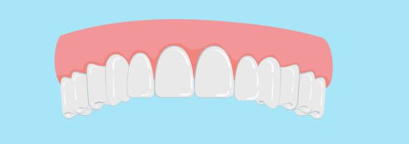 Illustration of an upper set of teeth, with gums, showing a missing tooth and exposed bone.
